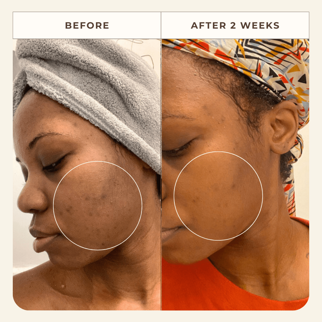 Before and after images showing the results of using Apoterra Neroli Clarifying Complexion Mist toner for clearer skin.