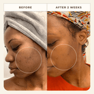 Before and after images showing the results of using Apoterra Neroli Clarifying Complexion Mist toner for clearer skin.